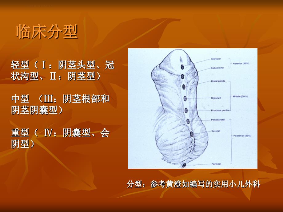 尿道下裂分型的图片图片