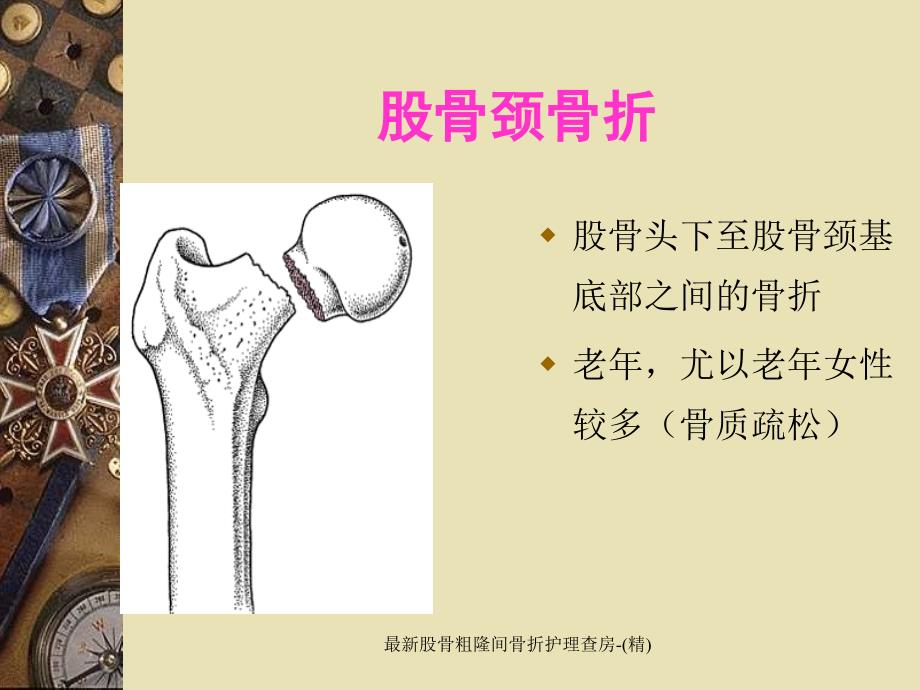 最新股骨粗隆間骨折護理查房精