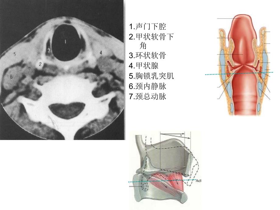 喉部MRI断层解剖图片