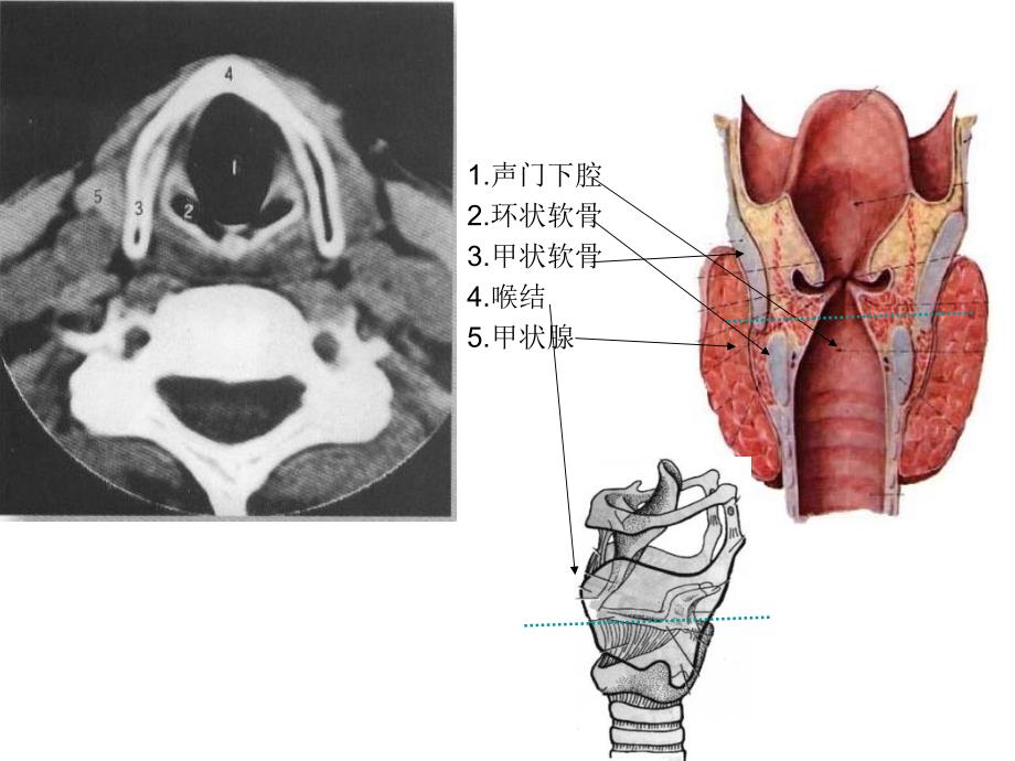 口咽部ct解剖图图片