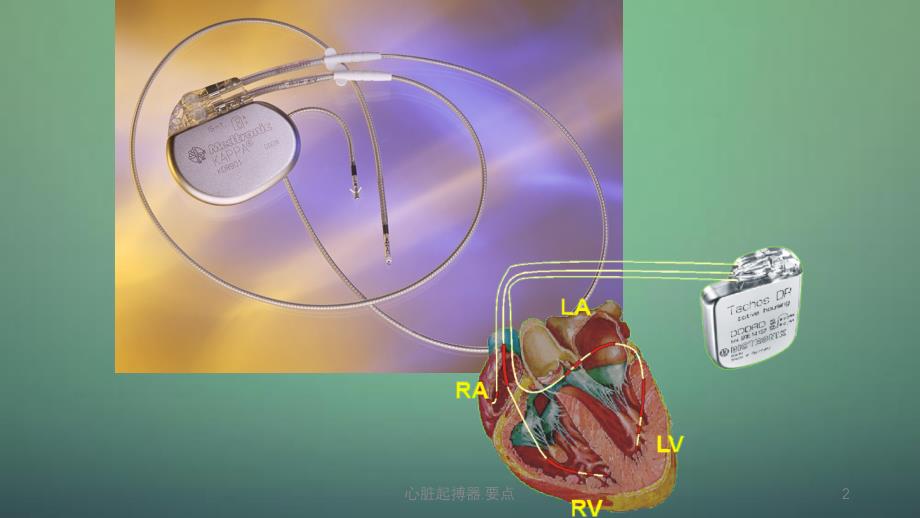 体内起搏器图片