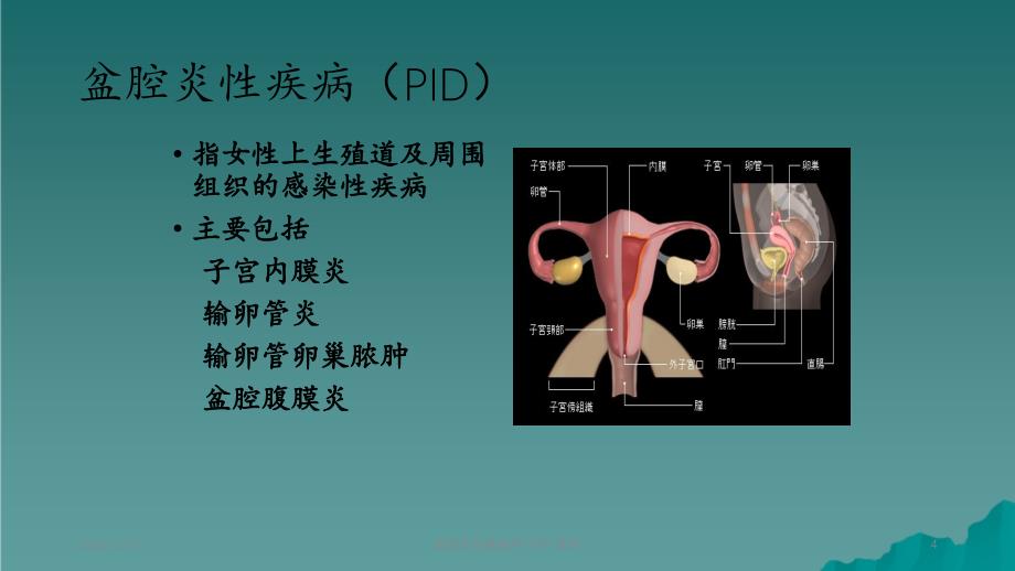 盆腔炎性疾病學習精品收藏