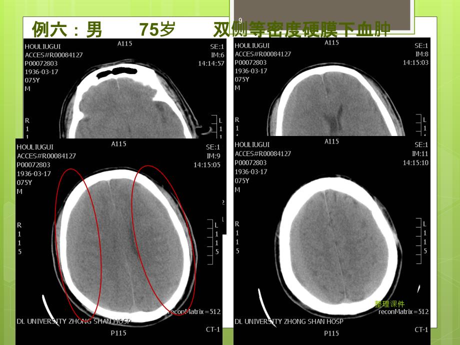 等密度硬膜下血腫的ct徵象1